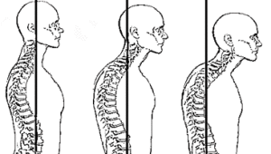 Forward-Head-Posture1