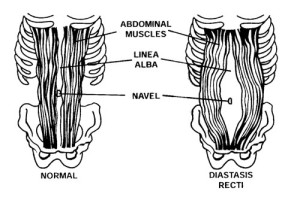 diastasis-recti
