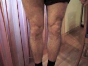 vmo rehab