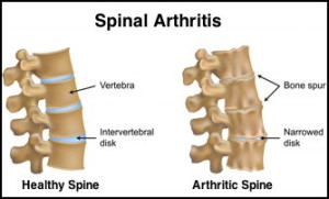 Osteoarthritis_Spine