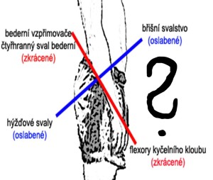 Dolní zkřížený syndrom
