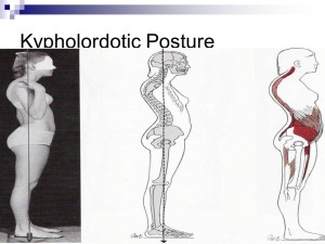 Kypholordotic Posture